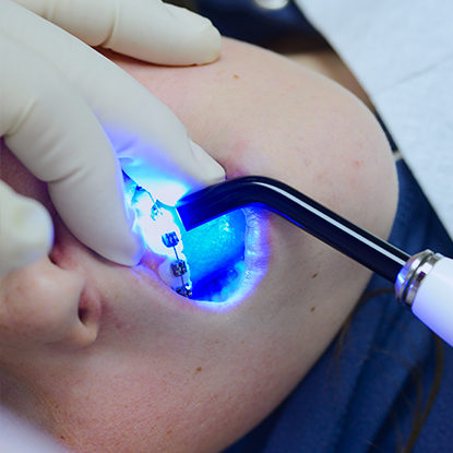 L’arrivée des « bagues »